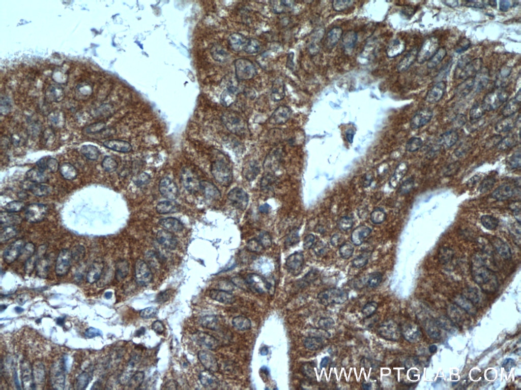 Immunohistochemistry (IHC) staining of human colon cancer tissue using ADRP/Perilipin 2 Polyclonal antibody (15294-1-AP)