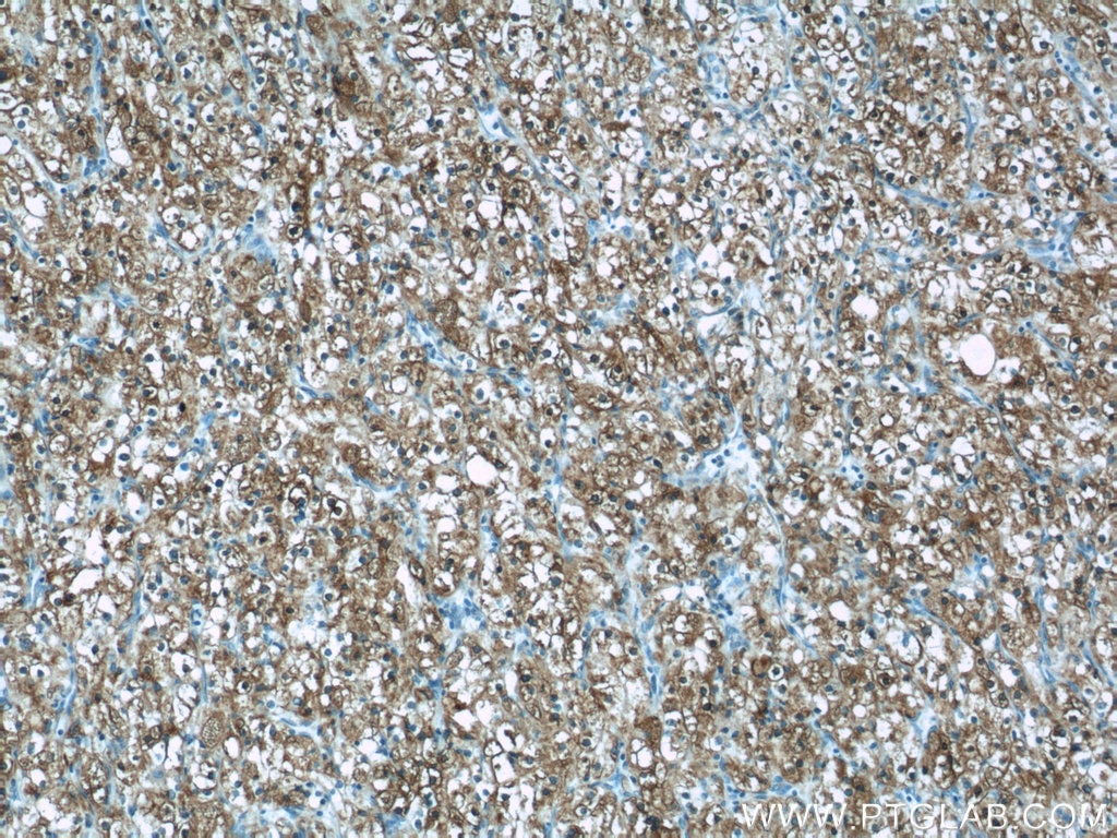 Immunohistochemistry (IHC) staining of human renal cell carcinoma tissue using ADRP/Perilipin 2 Polyclonal antibody (15294-1-AP)