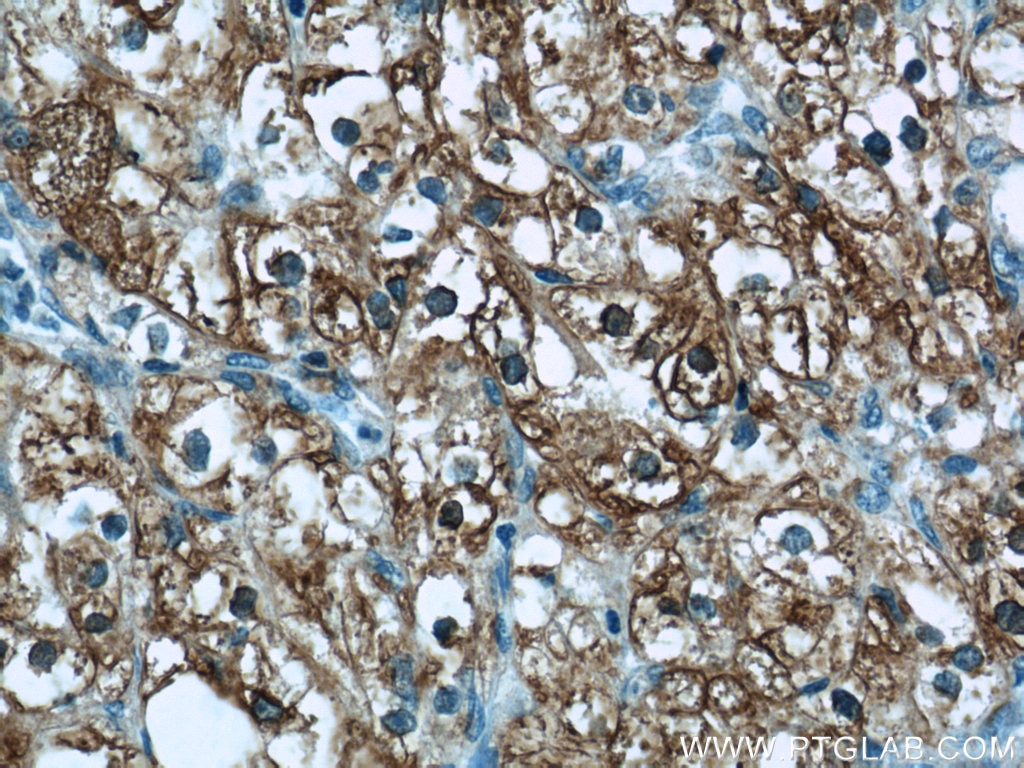 Immunohistochemistry (IHC) staining of human renal cell carcinoma tissue using ADRP/Perilipin 2 Polyclonal antibody (15294-1-AP)