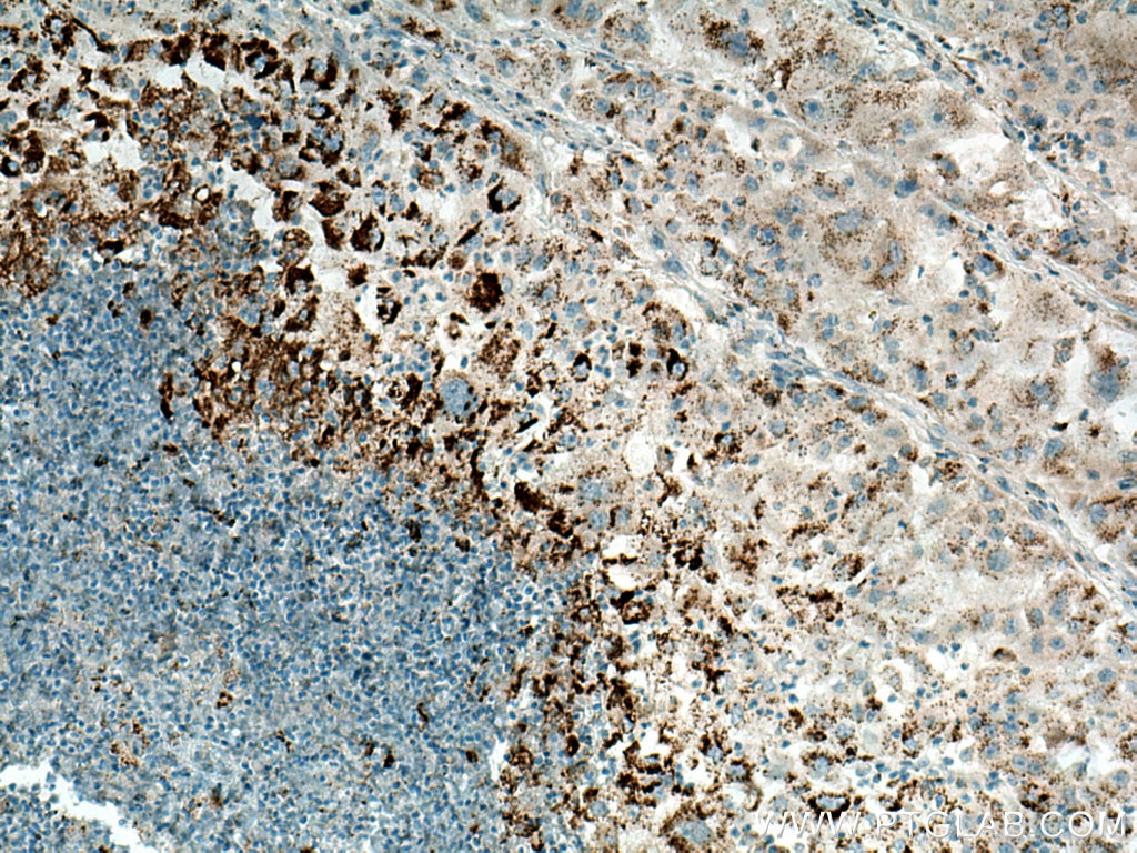 Immunohistochemistry (IHC) staining of human liver cancer tissue using ADRP/Perilipin 2 Polyclonal antibody (15294-1-AP)