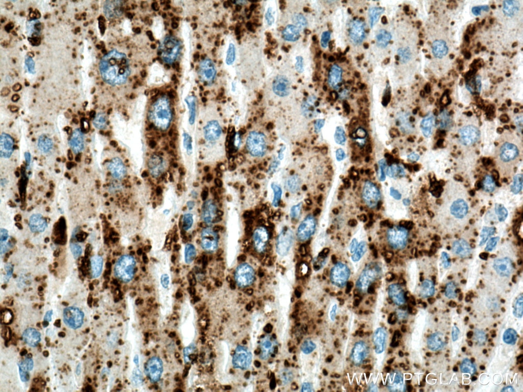 Immunohistochemistry (IHC) staining of human liver cancer tissue using ADRP/Perilipin 2 Polyclonal antibody (15294-1-AP)