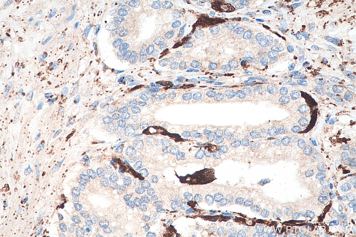 Immunohistochemistry (IHC) staining of human prostate cancer tissue using ADRP/Perilipin 2 Polyclonal antibody (15294-1-AP)