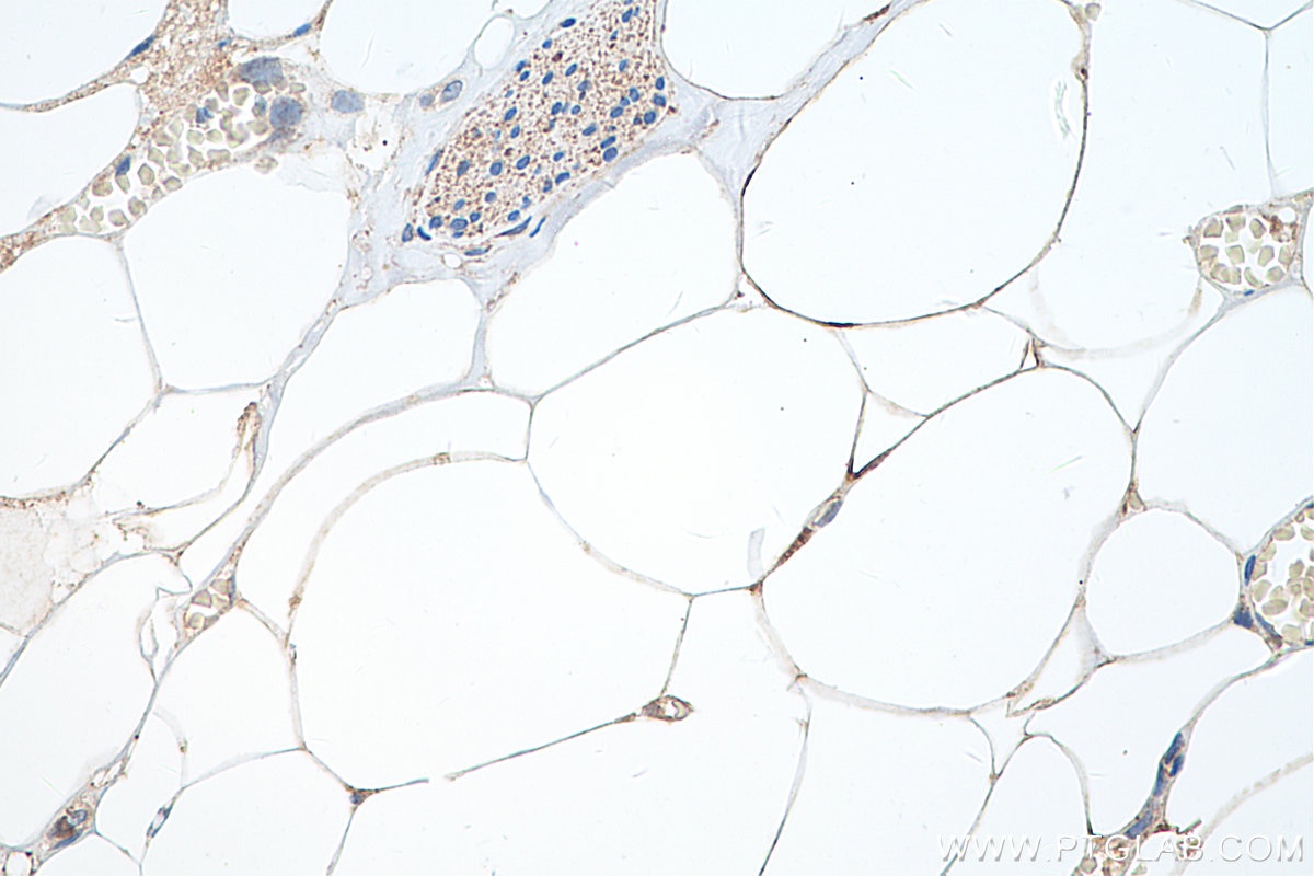 Immunohistochemistry (IHC) staining of human prostate cancer tissue using ADRP/Perilipin 2 Polyclonal antibody (15294-1-AP)