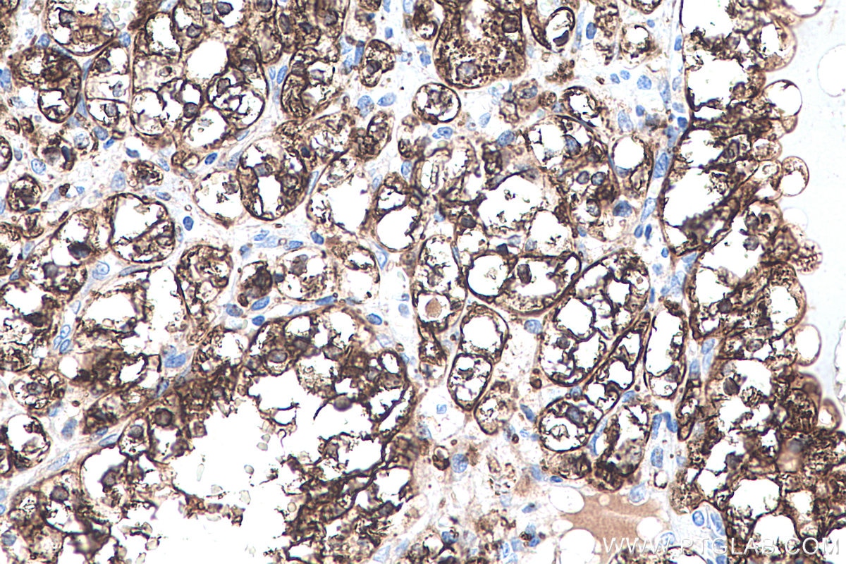 Immunohistochemistry (IHC) staining of human renal cell carcinoma tissue using ADRP/Perilipin 2 Monoclonal antibody (60340-1-Ig)