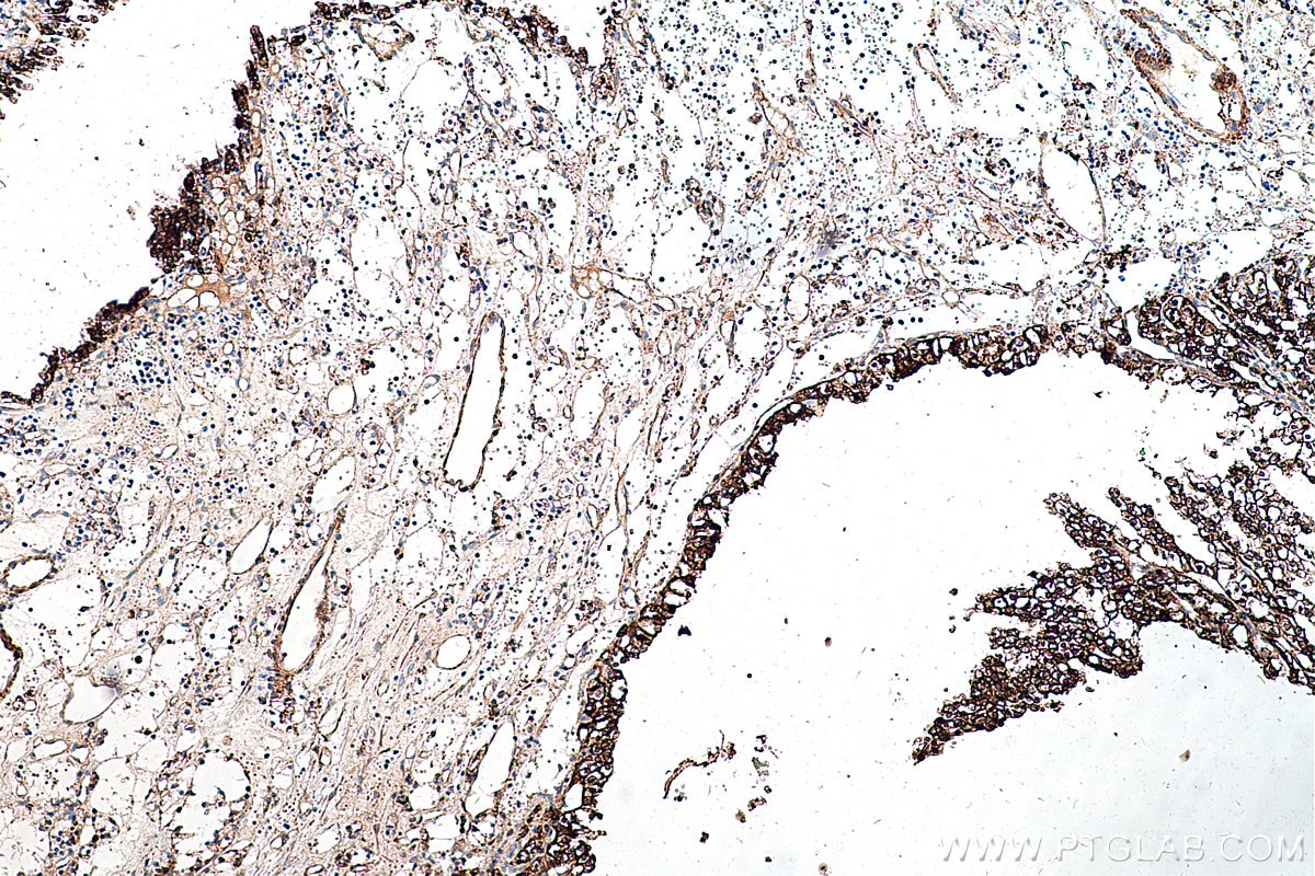 IHC staining of human renal cell carcinoma using 60340-1-Ig