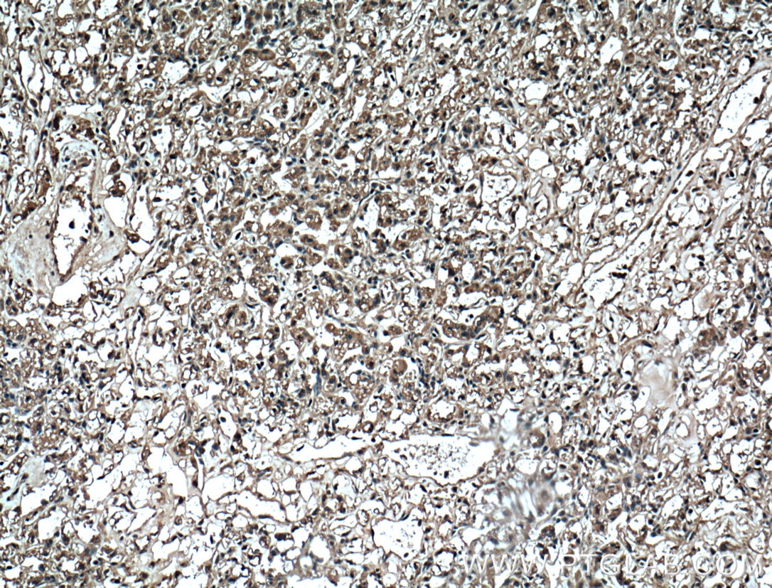 Immunohistochemistry (IHC) staining of human renal cell carcinoma tissue using ADRP/Perilipin 2 Monoclonal antibody (60340-1-Ig)