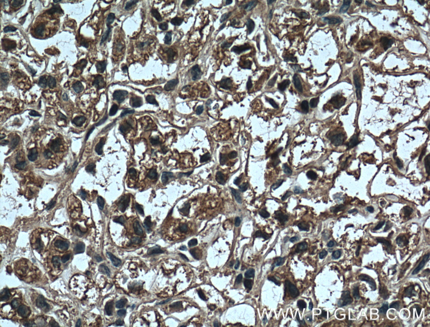 Immunohistochemistry (IHC) staining of human renal cell carcinoma tissue using ADRP/Perilipin 2 Monoclonal antibody (60340-1-Ig)