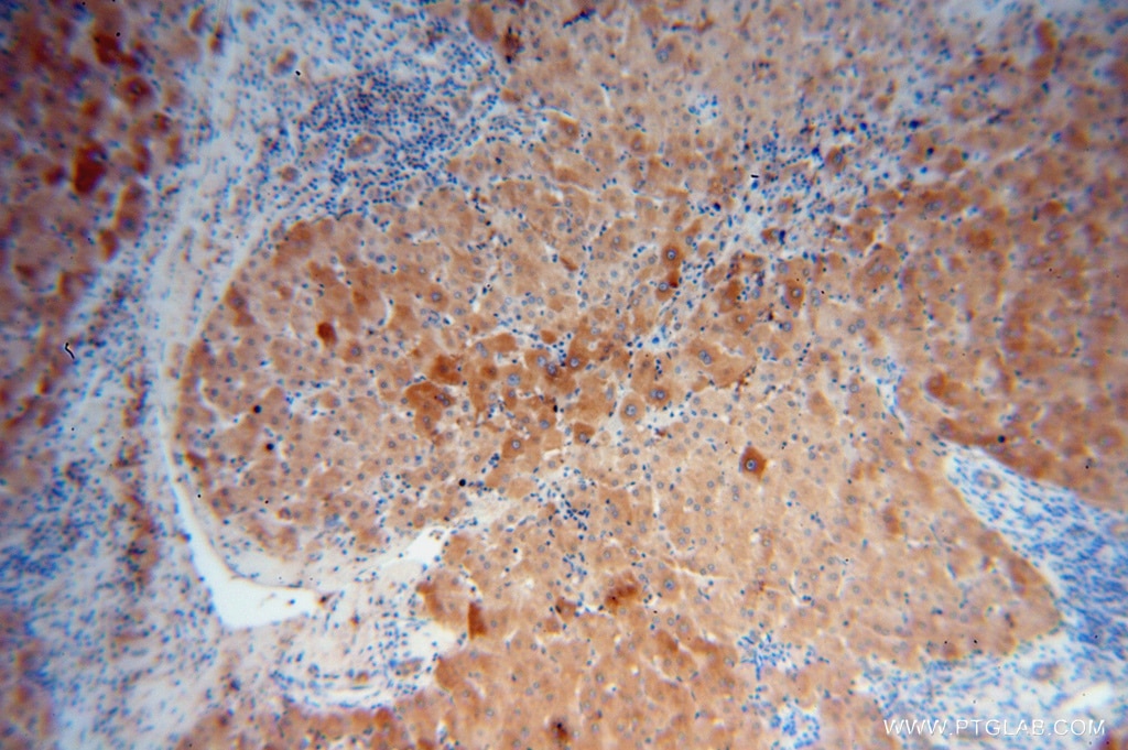 Immunohistochemistry (IHC) staining of human liver cancer tissue using Adenylosuccinate lyase Polyclonal antibody (15264-1-AP)