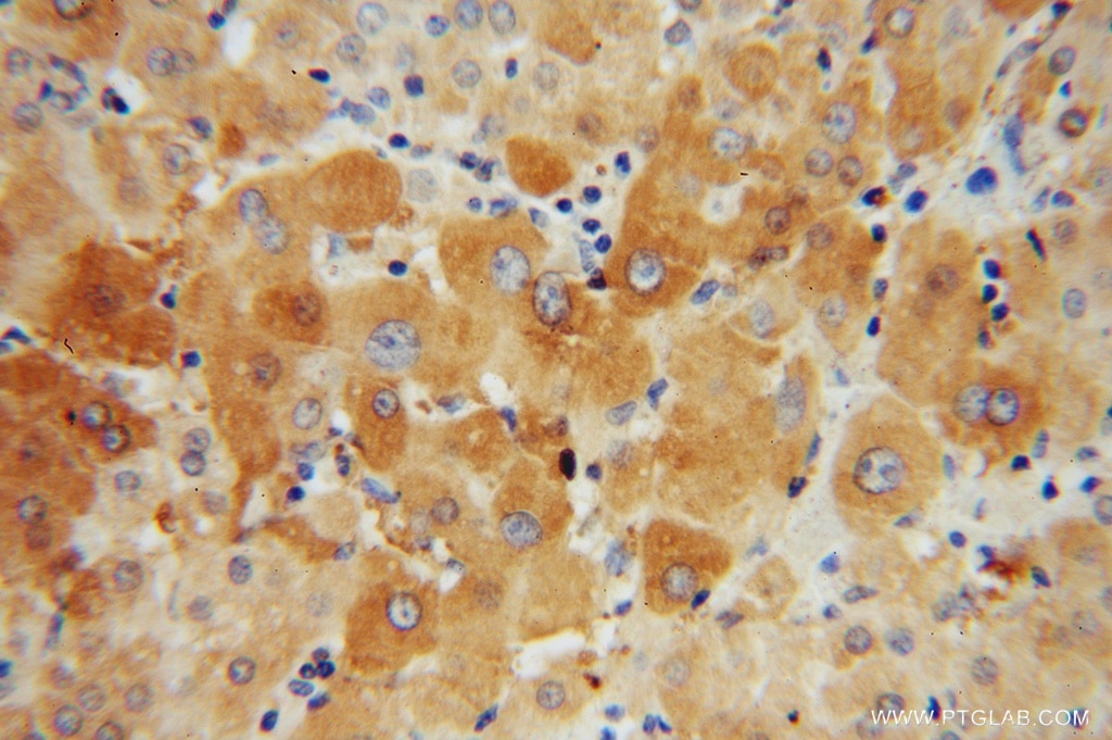 Immunohistochemistry (IHC) staining of human liver cancer tissue using Adenylosuccinate lyase Polyclonal antibody (15264-1-AP)