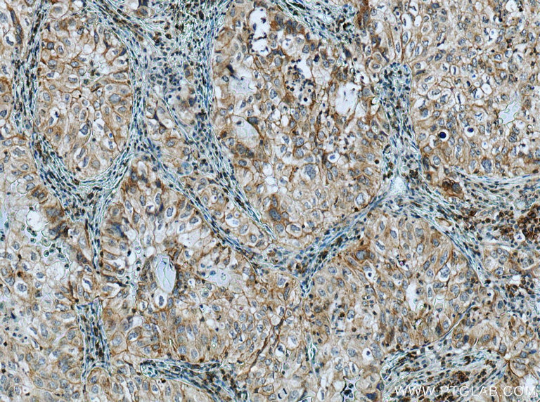 Immunohistochemistry (IHC) staining of human lung cancer tissue using AE2 Polyclonal antibody (26332-1-AP)