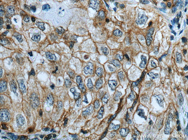 Immunohistochemistry (IHC) staining of human lung cancer tissue using AE2 Polyclonal antibody (26332-1-AP)