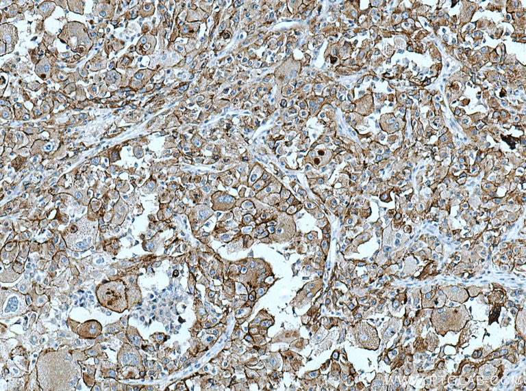 Immunohistochemistry (IHC) staining of human liver cancer tissue using AE2 Polyclonal antibody (26332-1-AP)