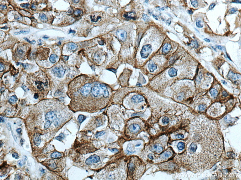 Immunohistochemistry (IHC) staining of human liver cancer tissue using AE2 Polyclonal antibody (26332-1-AP)