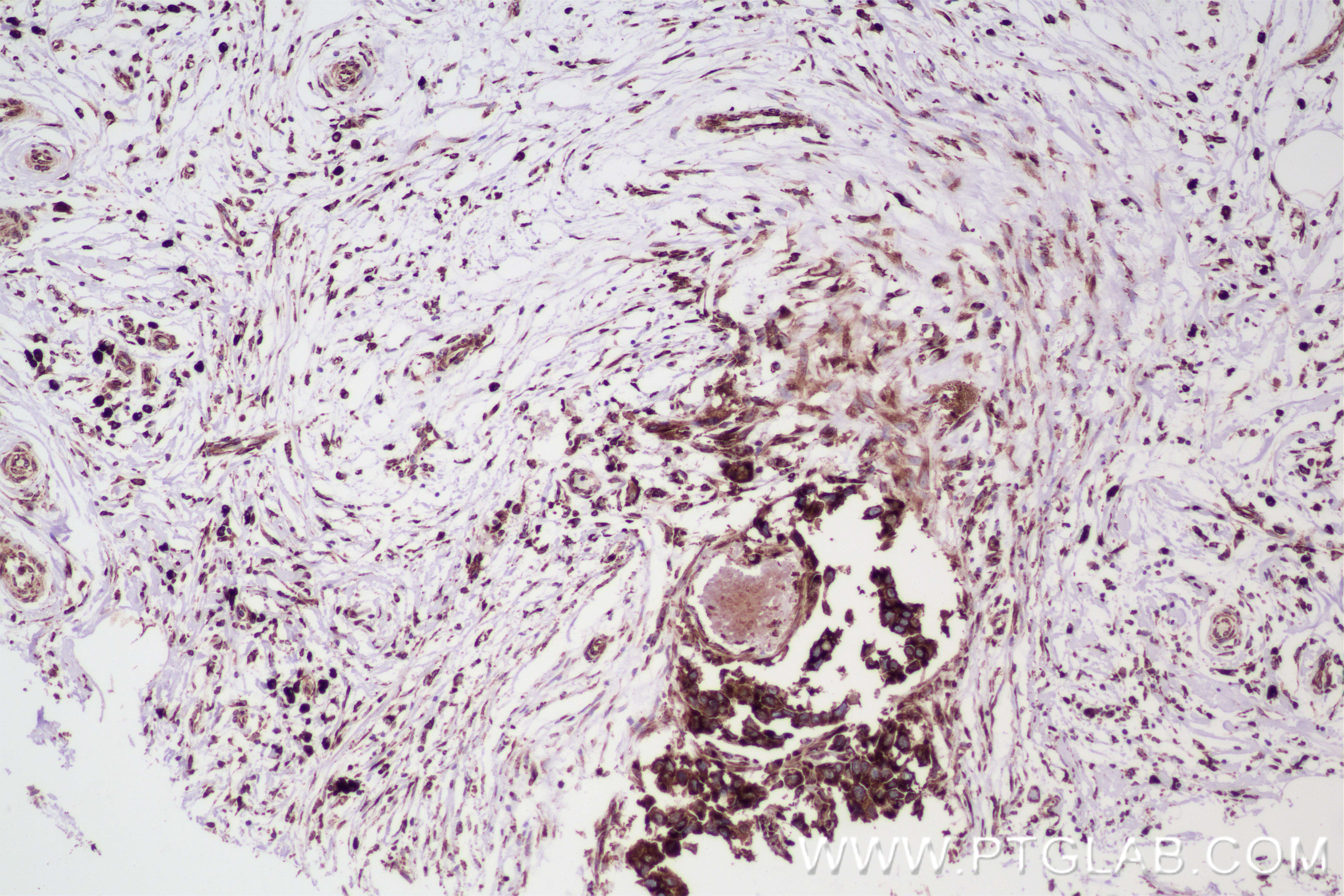 IHC staining of human breast cancer using 84686-4-RR Immunohistochemistry (IHC) staining of human breast cancer tissue using AEG-1/MTDH Recombinant monoclonal antibody (84686-4-RR)