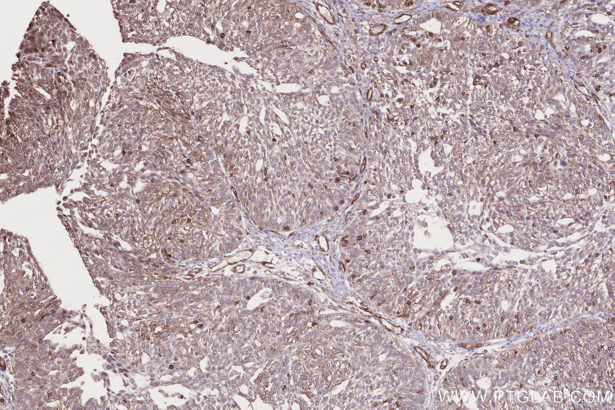 Immunohistochemistry (IHC) staining of human ovary cancer tissue using AFAP1L2 Polyclonal antibody (17183-1-AP)