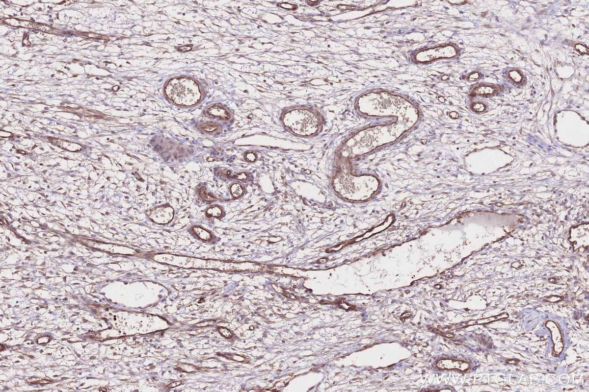 Immunohistochemistry (IHC) staining of human ovary cancer tissue using AFAP1L2 Polyclonal antibody (17183-1-AP)