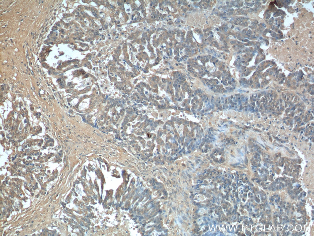 Immunohistochemistry (IHC) staining of human ovary tumor tissue using AFP Polyclonal antibody (14550-1-AP)