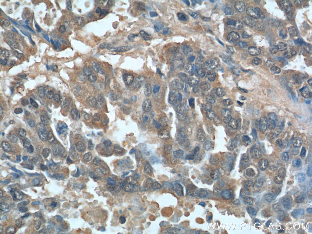 IHC staining of human ovary tumor using 14550-1-AP