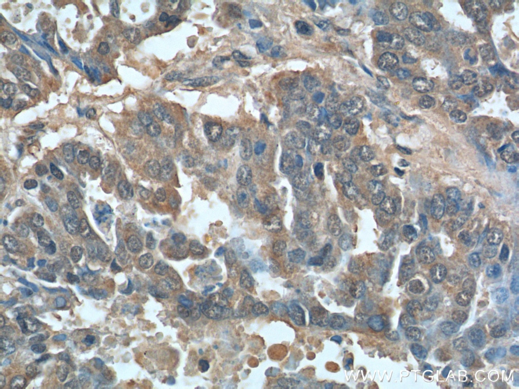 Immunohistochemistry (IHC) staining of human ovary tumor tissue using AFP Polyclonal antibody (14550-1-AP)