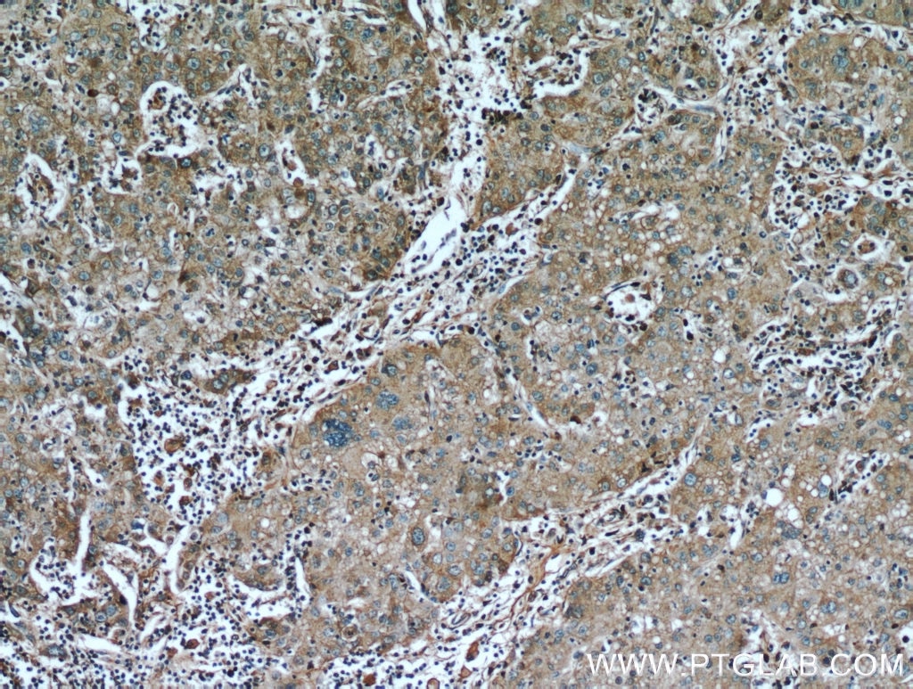 Immunohistochemistry (IHC) staining of human liver cancer tissue using AFP Polyclonal antibody (14550-1-AP)