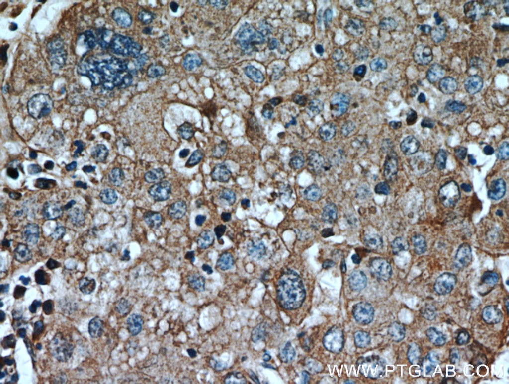 Immunohistochemistry (IHC) staining of human liver cancer tissue using AFP Polyclonal antibody (14550-1-AP)