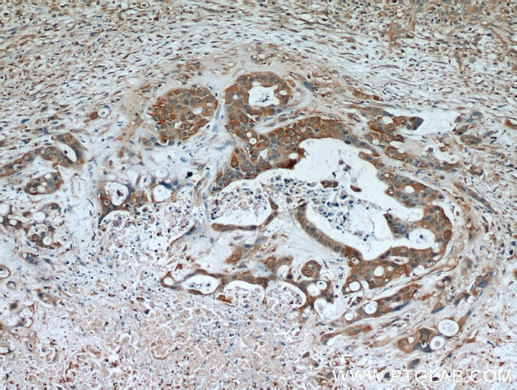 Immunohistochemistry (IHC) staining of human liver cancer tissue using AFP Polyclonal antibody (14550-1-AP)