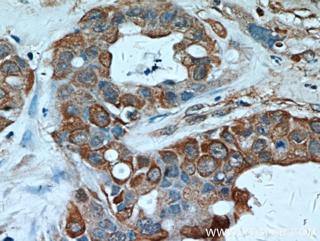 IHC staining of human liver cancer using 14550-1-AP