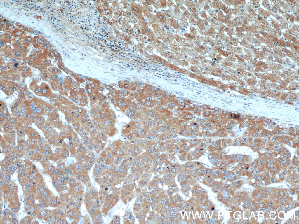 Immunohistochemistry (IHC) staining of human liver cancer tissue using AFP Polyclonal antibody (14550-1-AP)