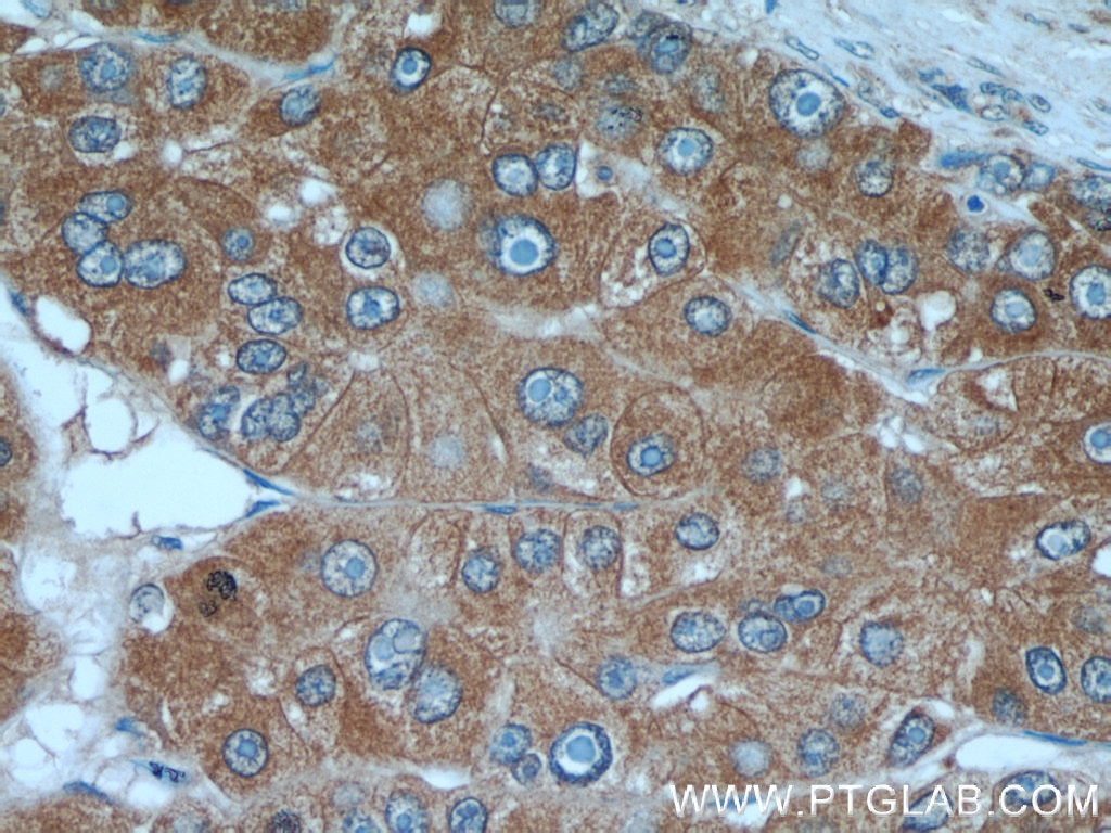 Immunohistochemistry (IHC) staining of human liver cancer tissue using AFP Polyclonal antibody (14550-1-AP)