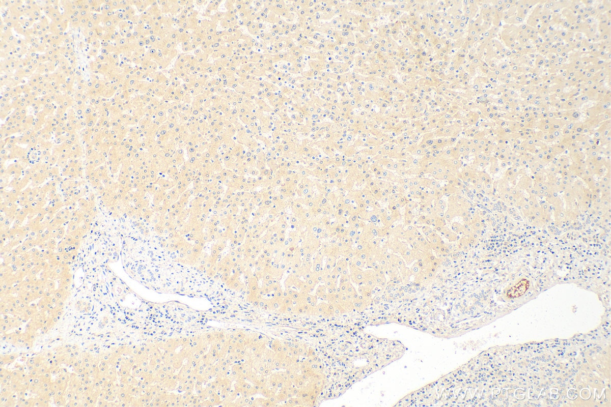 Immunohistochemistry (IHC) staining of human hepatocirrhosis tissue using AFP Polyclonal antibody (32214-1-AP)