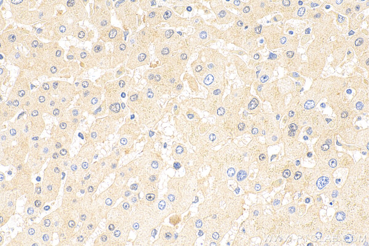 Immunohistochemistry (IHC) staining of human hepatocirrhosis tissue using AFP Polyclonal antibody (32214-1-AP)