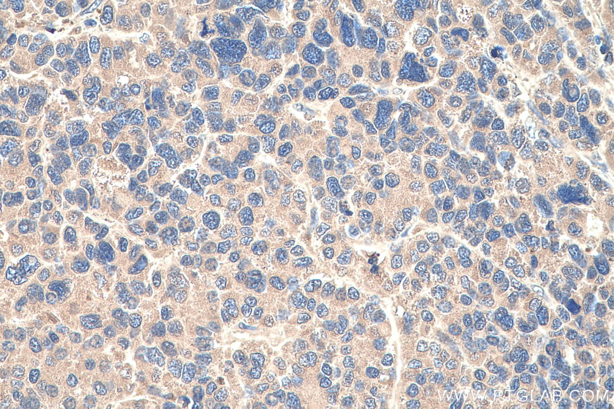 Immunohistochemistry (IHC) staining of human liver cancer tissue using AFP Monoclonal antibody (67852-1-Ig)