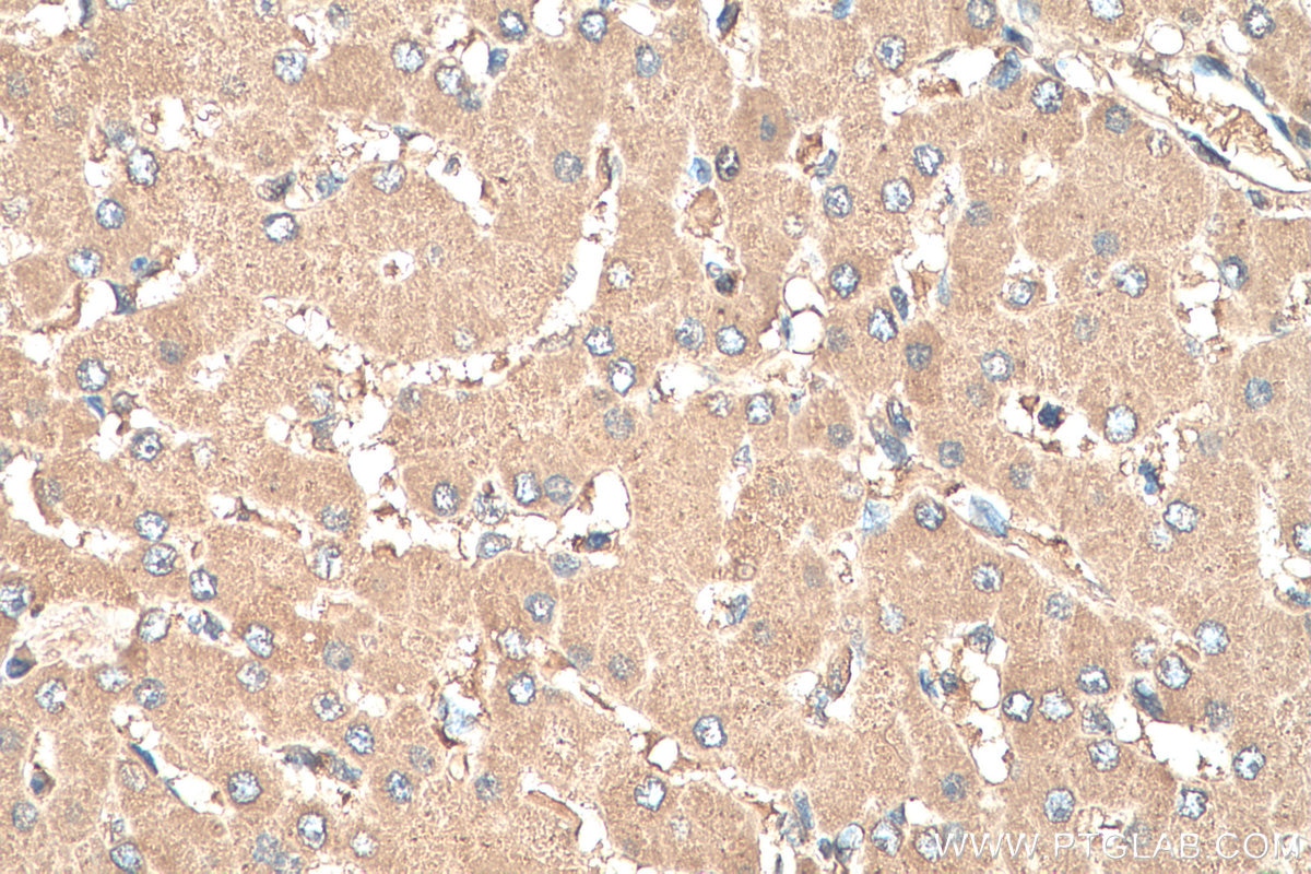 Immunohistochemistry (IHC) staining of human liver tissue using AFP Monoclonal antibody (67852-1-Ig)