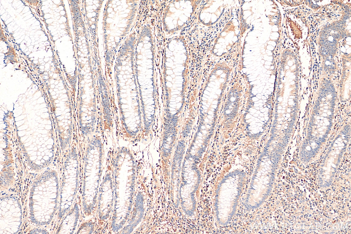 Immunohistochemistry (IHC) staining of human colon cancer tissue using AFP Recombinant antibody (81083-1-RR)
