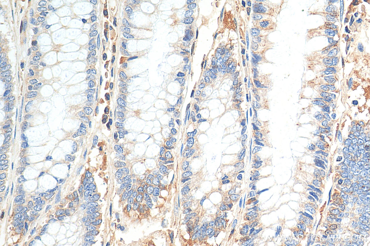 Immunohistochemistry (IHC) staining of human colon cancer tissue using AFP Recombinant antibody (81083-1-RR)