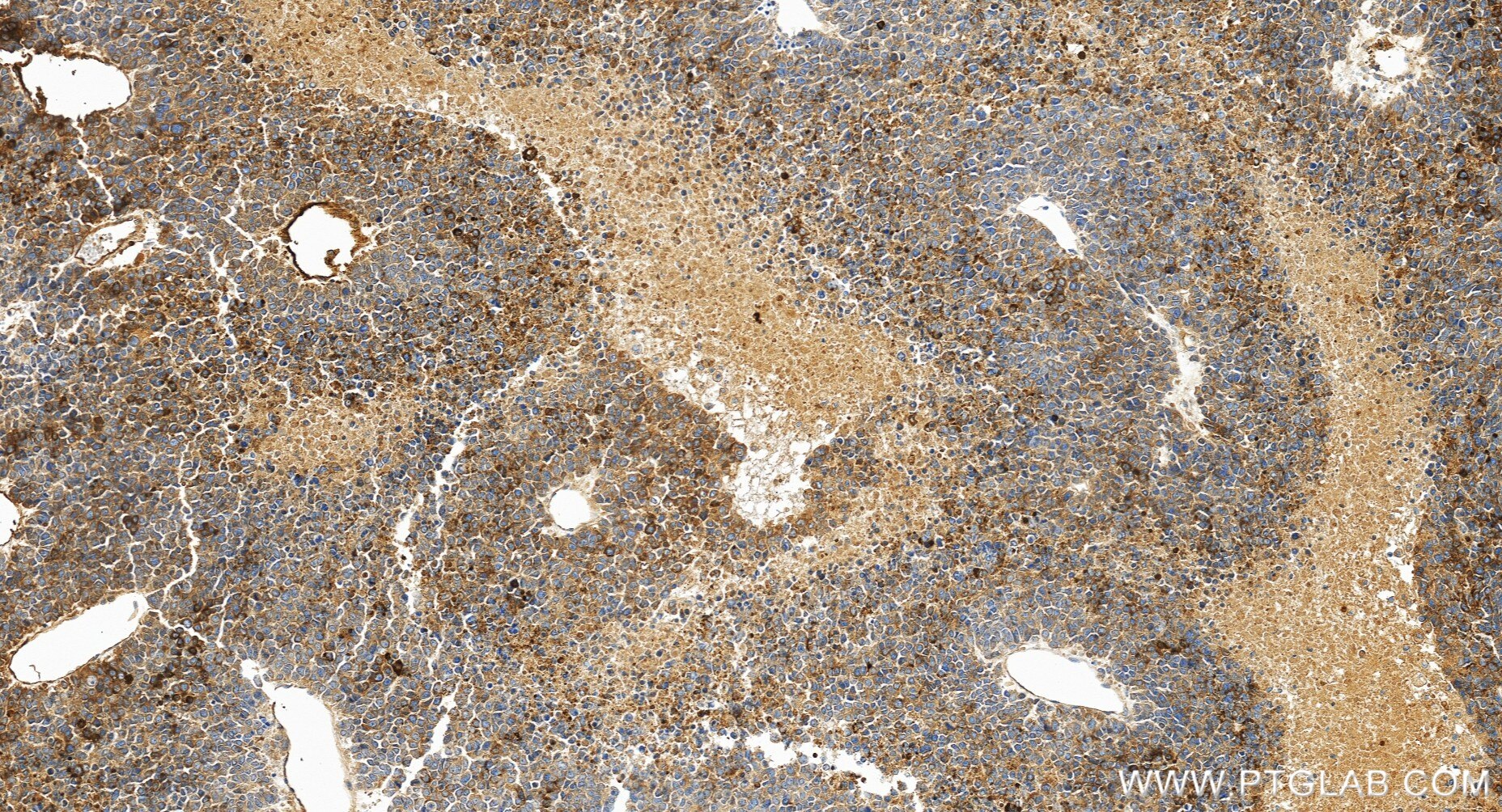 Immunohistochemistry (IHC) staining of human liver cancer tissue using AFP Recombinant monoclonal antibody (82982-6-RR)
