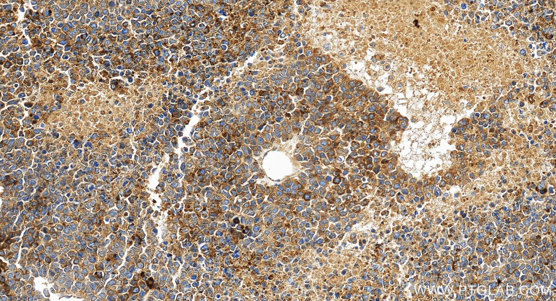 Immunohistochemistry (IHC) staining of human liver cancer tissue using AFP Recombinant monoclonal antibody (82982-6-RR)