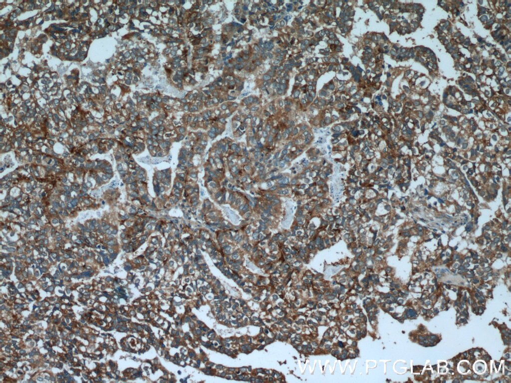 Immunohistochemistry (IHC) staining of human breast cancer tissue using AGA Polyclonal antibody (17299-1-AP)