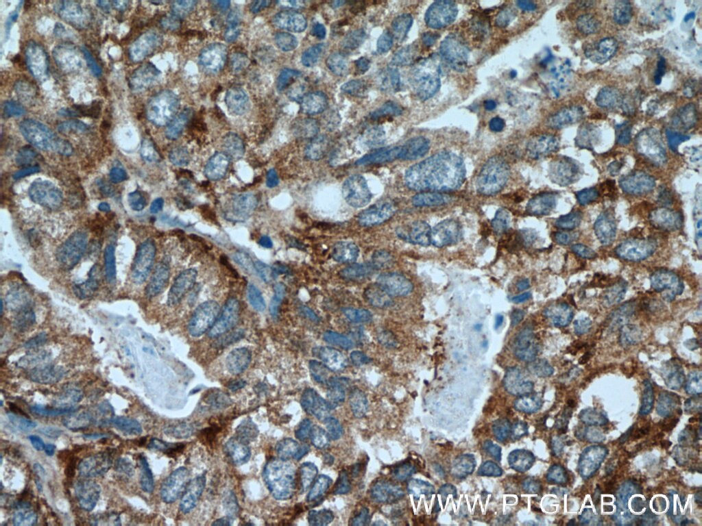 Immunohistochemistry (IHC) staining of human breast cancer tissue using AGA Polyclonal antibody (17299-1-AP)