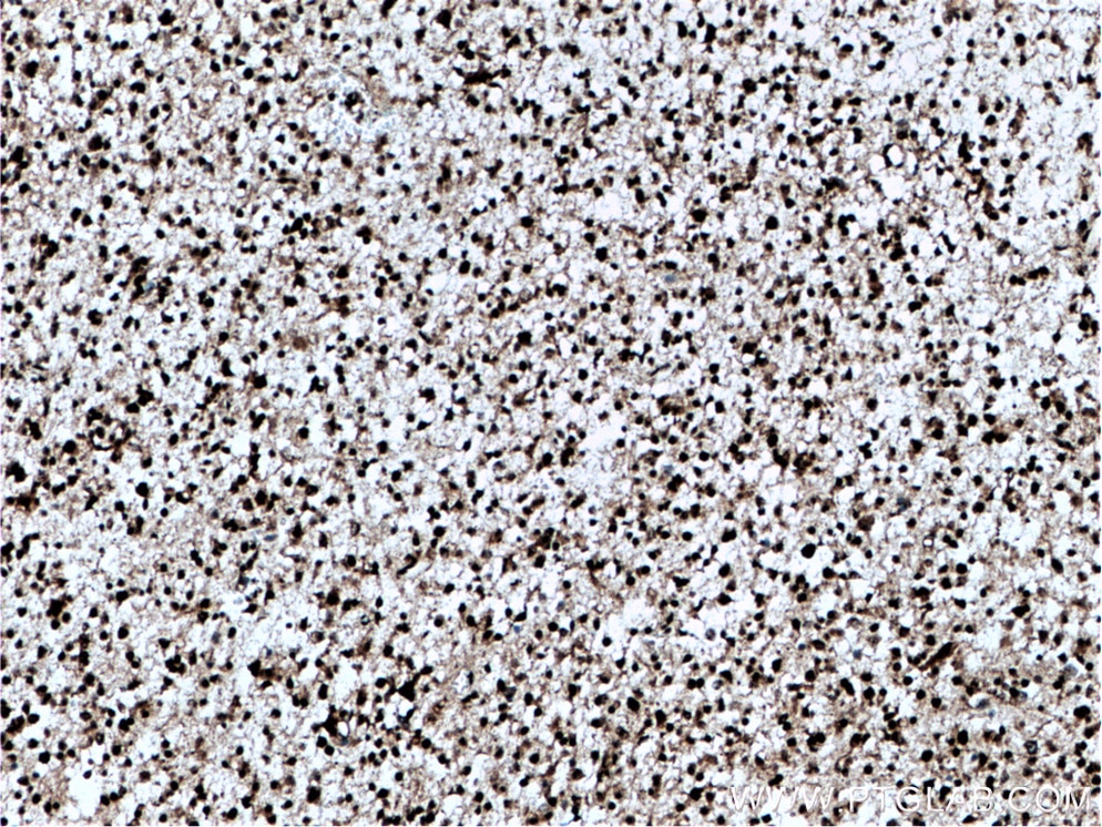 Immunohistochemistry (IHC) staining of human gliomas tissue using AGAP2 Polyclonal antibody (14690-1-AP)