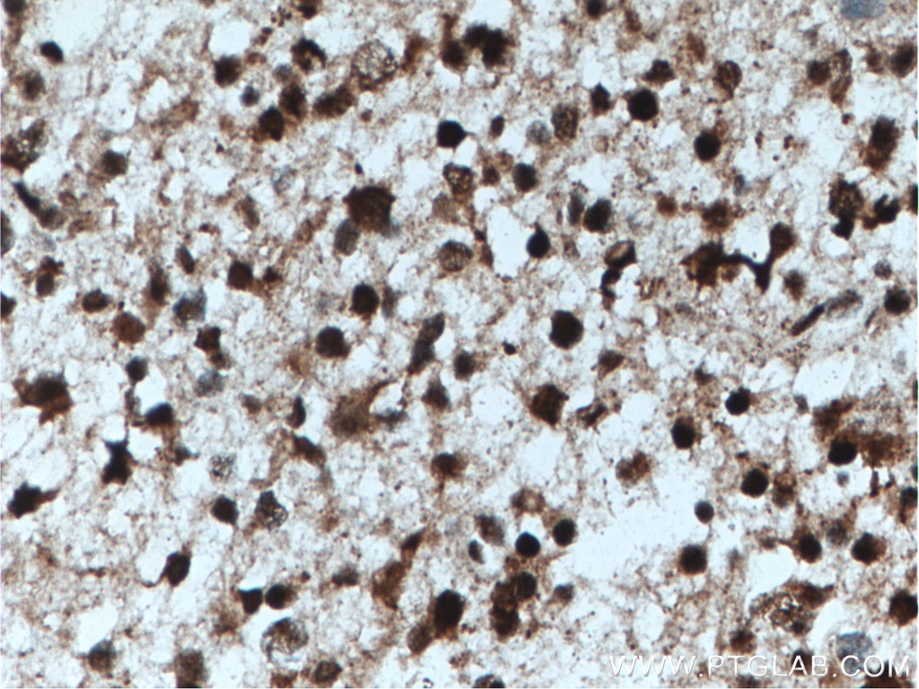 Immunohistochemistry (IHC) staining of human gliomas tissue using AGAP2 Polyclonal antibody (14690-1-AP)