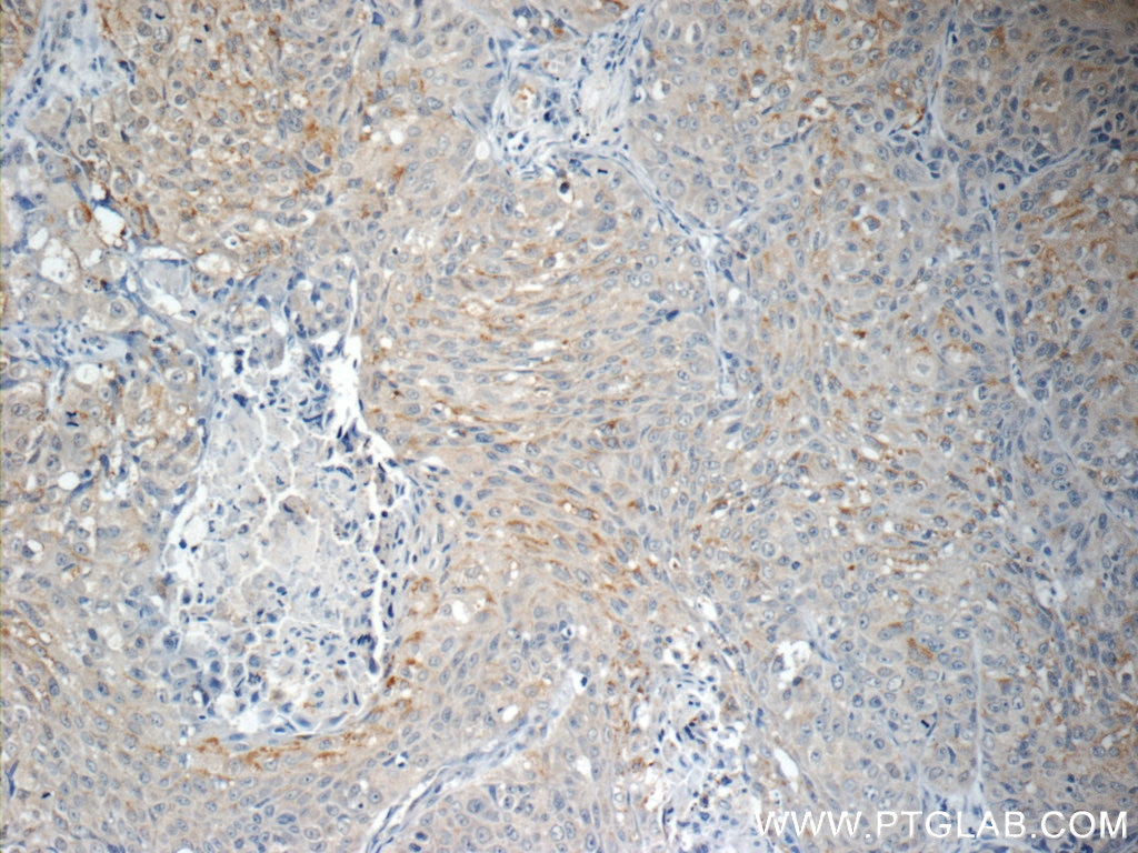 Immunohistochemistry (IHC) staining of human lung cancer tissue using AGBL3 Polyclonal antibody (16990-1-AP)