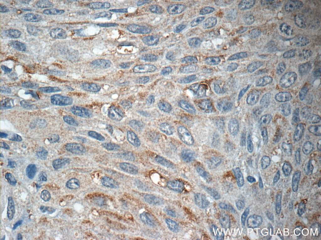 Immunohistochemistry (IHC) staining of human lung cancer tissue using AGBL3 Polyclonal antibody (16990-1-AP)