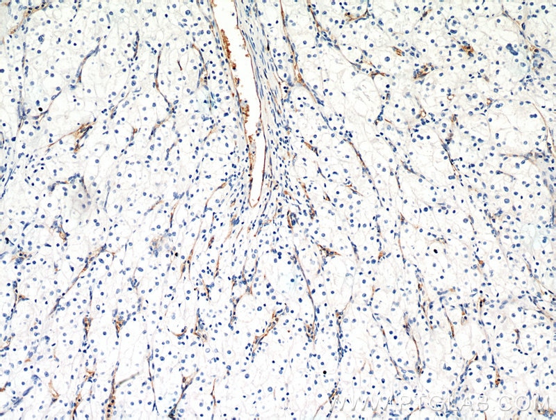 IHC staining of human renal cell carcinoma using 16346-1-AP