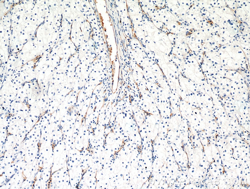 Immunohistochemistry (IHC) staining of human renal cell carcinoma tissue using AGER Polyclonal antibody (16346-1-AP)