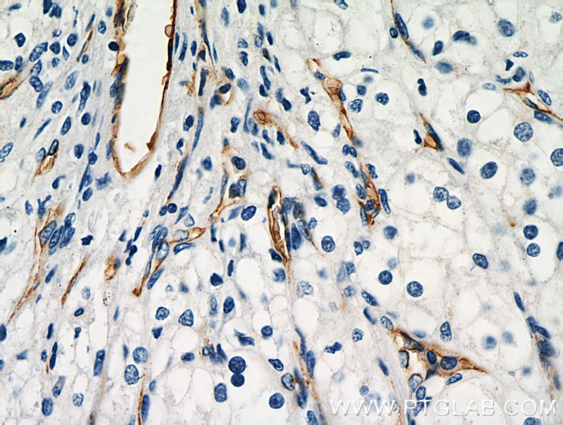 Immunohistochemistry (IHC) staining of human renal cell carcinoma tissue using AGER Polyclonal antibody (16346-1-AP)