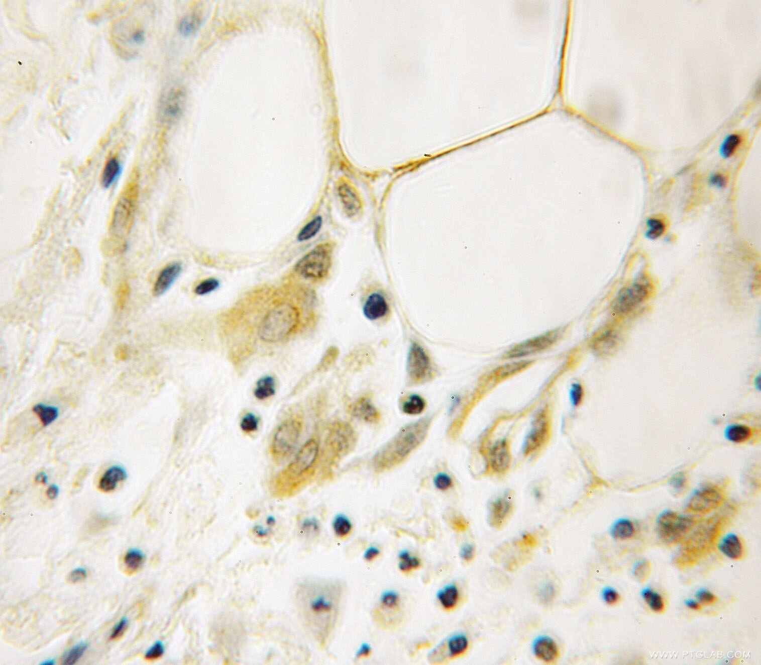 Immunohistochemistry (IHC) staining of human breast cancer tissue using AGFG1 Polyclonal antibody (12670-1-AP)