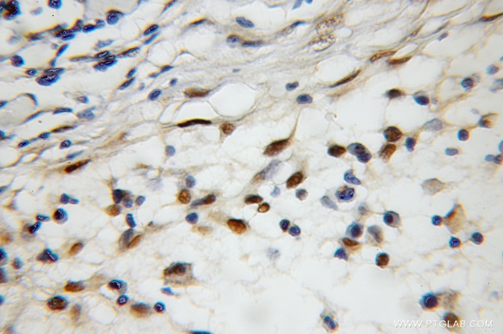 Immunohistochemistry (IHC) staining of human lymphoma tissue using AGFG2 Polyclonal antibody (11919-1-AP)