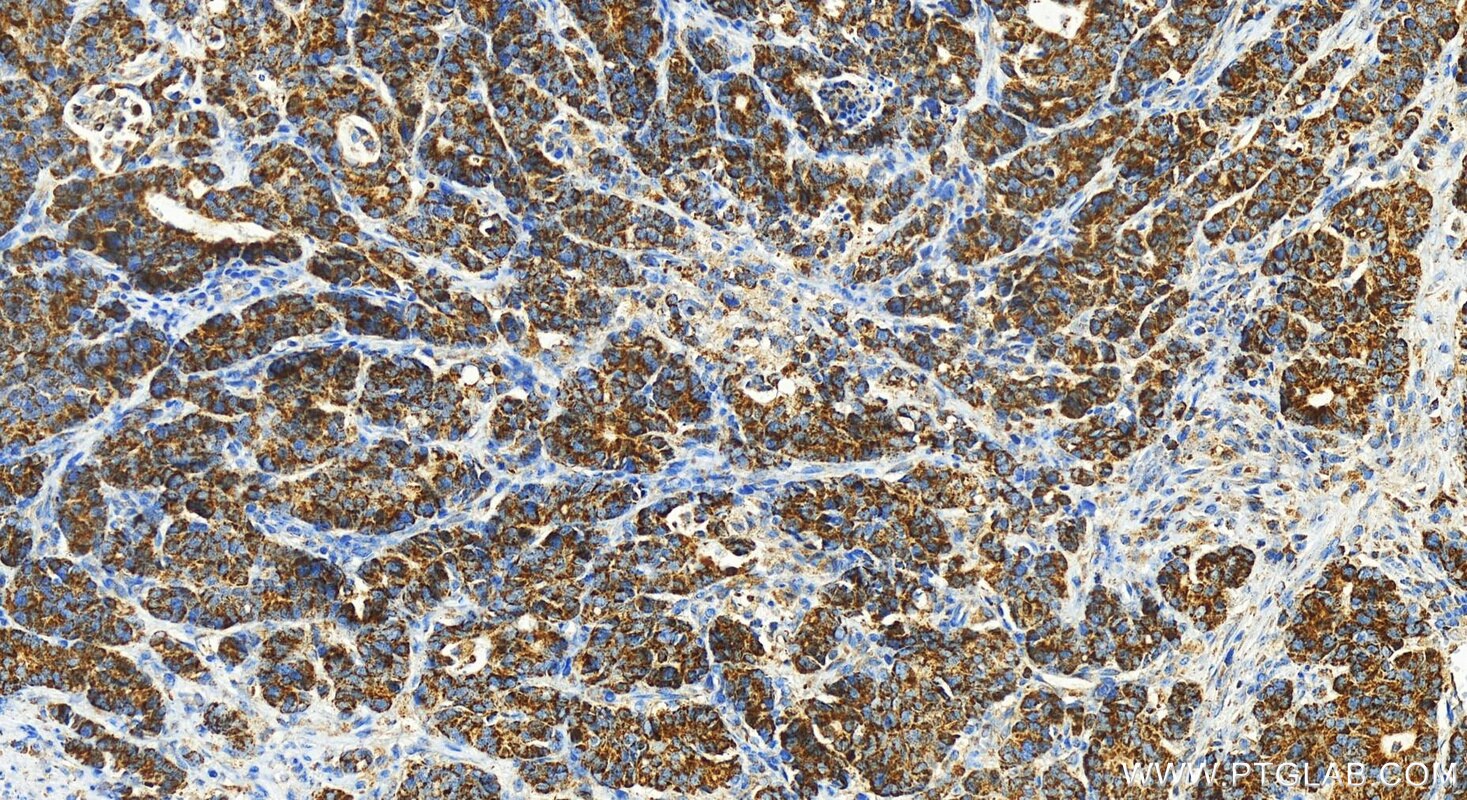 Immunohistochemistry (IHC) staining of human stomach cancer tissue using AGMAT Polyclonal antibody (21899-1-AP)