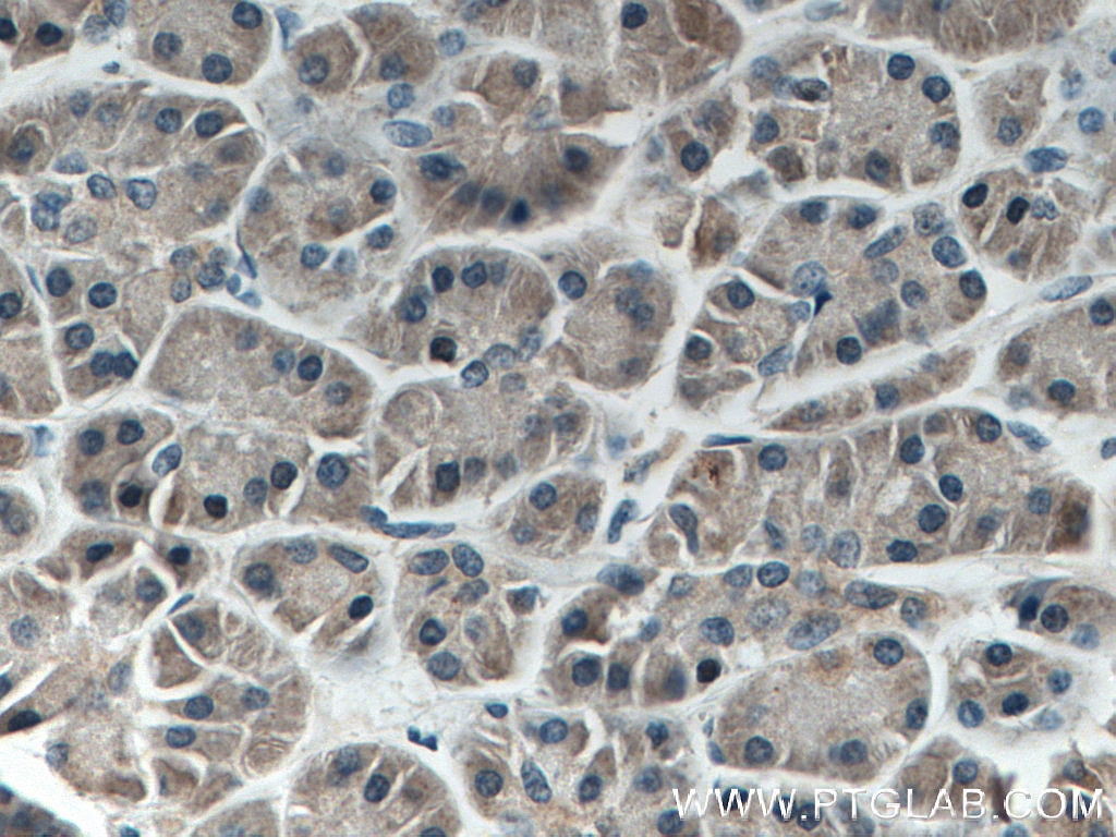 Immunohistochemistry (IHC) staining of human pancreas cancer tissue using AGO2 Monoclonal antibody (66720-1-Ig)